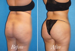 Brazilian Butt Lift Before and After Patient Thumbnail 2