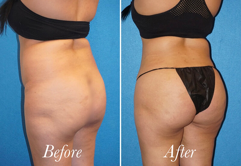 Brazilian Butt Lift Before and After Patient 4