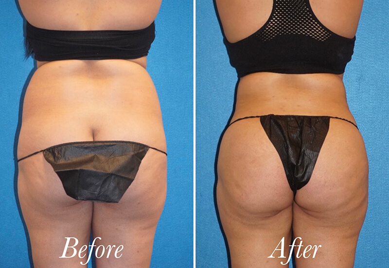 Brazilian Butt Lift Before and After Patient 1