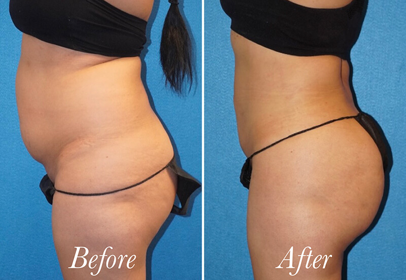 Brazilian Butt Lift Before and After Patient 5