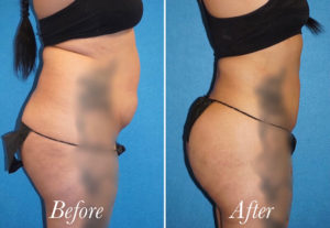 Brazilian Butt Lift Before and After Patient Thumbnail 3