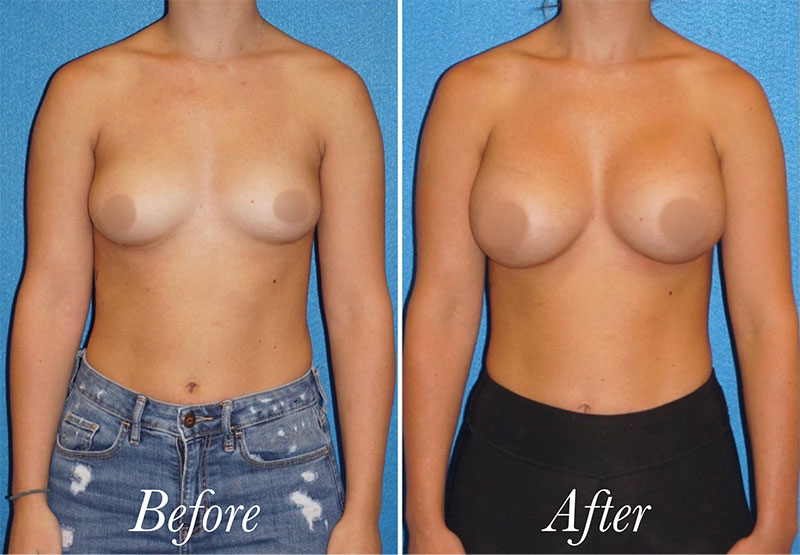 Breast Augmentation Before and After Patient 1