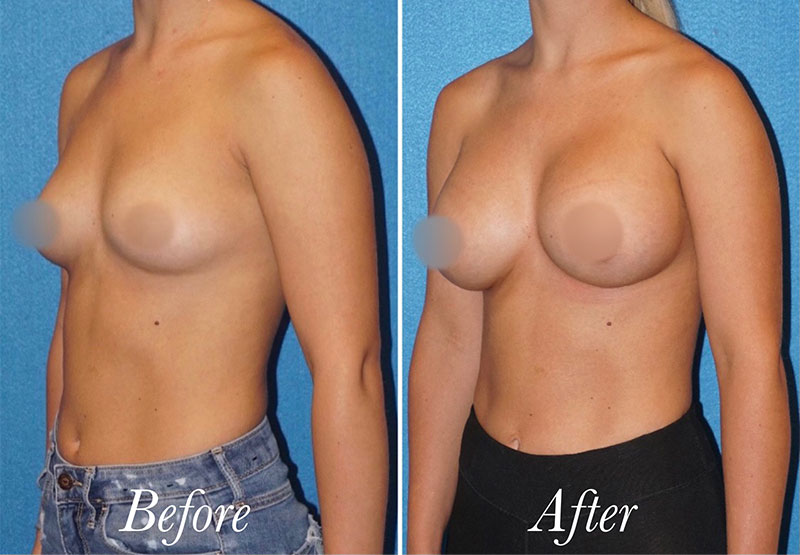 Breast Augmentation Before and After Patient 3