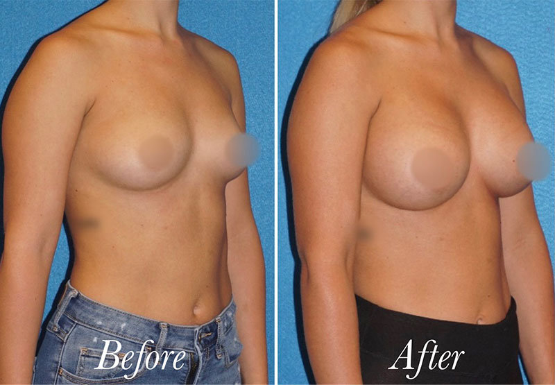 Breast Augmentation Before and After Patient 2