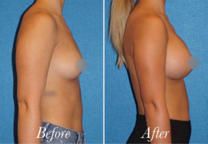 Breast Augmentation Before and After Patient Thumbnail 5