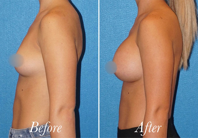 Breast Augmentation Before and After Patient 4