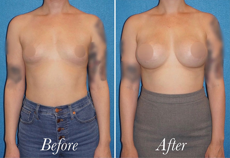 Breast Augmentation Before and After Patient 1