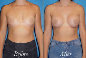 Breast Augmentation Before and After Patient Thumbnail 1