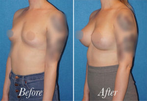 Breast Augmentation Before and After Patient Thumbnail 3
