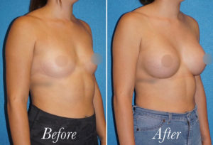 Breast Augmentation Before and After Patient Thumbnail 2
