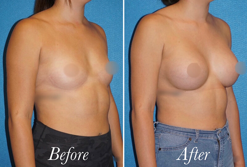 Breast Augmentation Before and After Patient 2