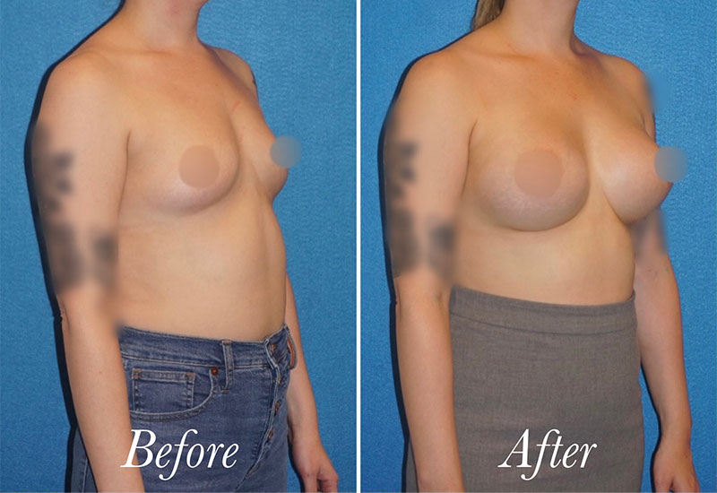 Breast Augmentation Before and After Patient 2