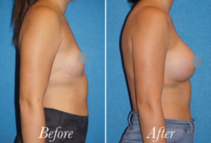 Breast Augmentation Before and After Patient Thumbnail 3