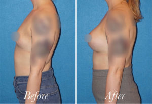 Breast Augmentation Before and After Patient Thumbnail 4