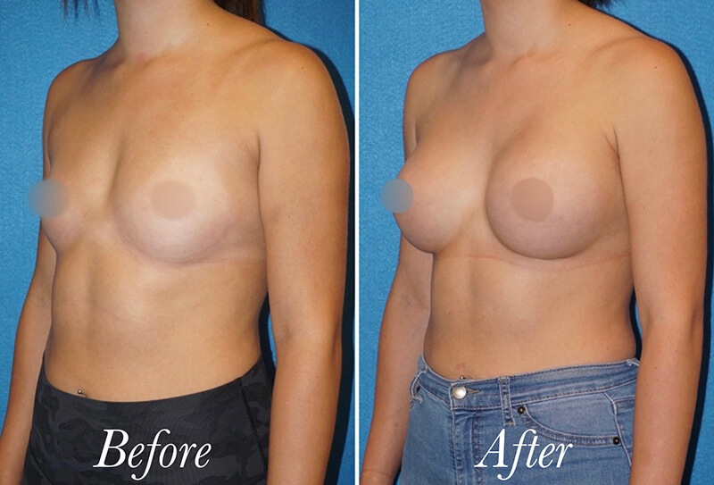 Breast Augmentation Before and After Patient 4