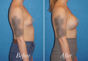Breast Augmentation Before and After Patient Thumbnail 5