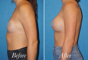 Breast Augmentation Before and After Patient Thumbnail 5