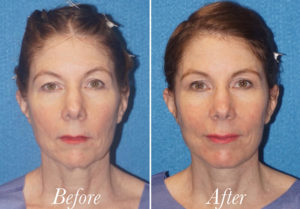 Facelift Before and After Patient Thumbnail 1