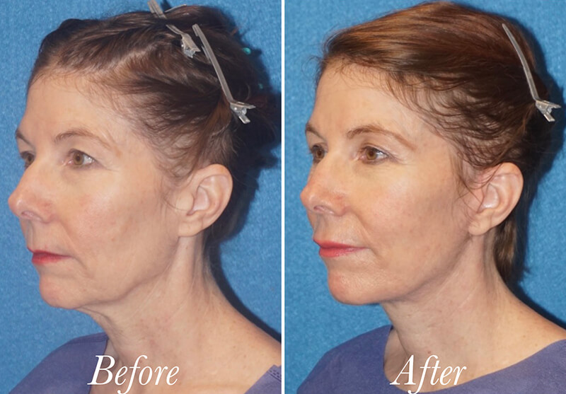 Facelift Before and After Patient 2