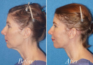 Facelift Before and After Patient Thumbnail 3
