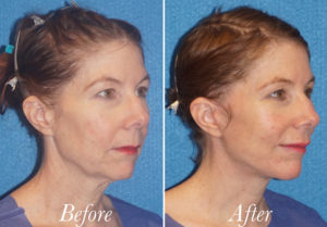 Facelift Before and After Patient Thumbnail 4