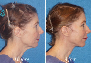 Facelift Before and After Patient Thumbnail 5