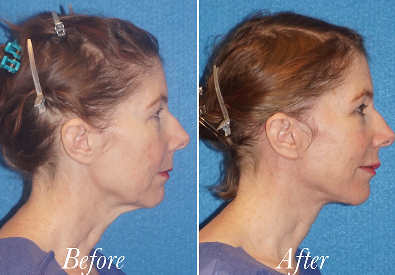 Facelift Before and After Patient 5