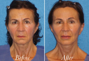 Facelift Before and After Patient Thumbnail 1