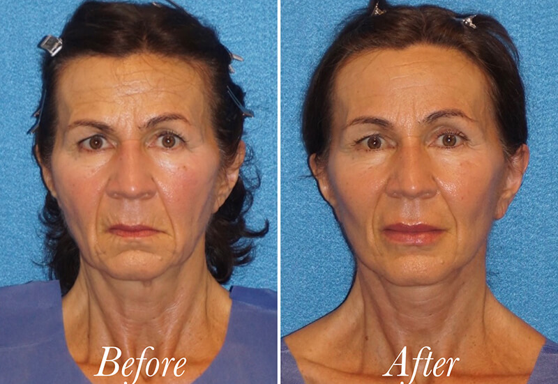 Facelift Before and After Patient 1