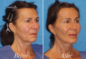 Facelift Before and After Patient Thumbnail 2