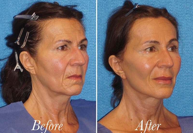 Facelift Before and After Patient 2
