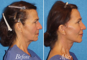 Facelift Before and After Patient Thumbnail 3