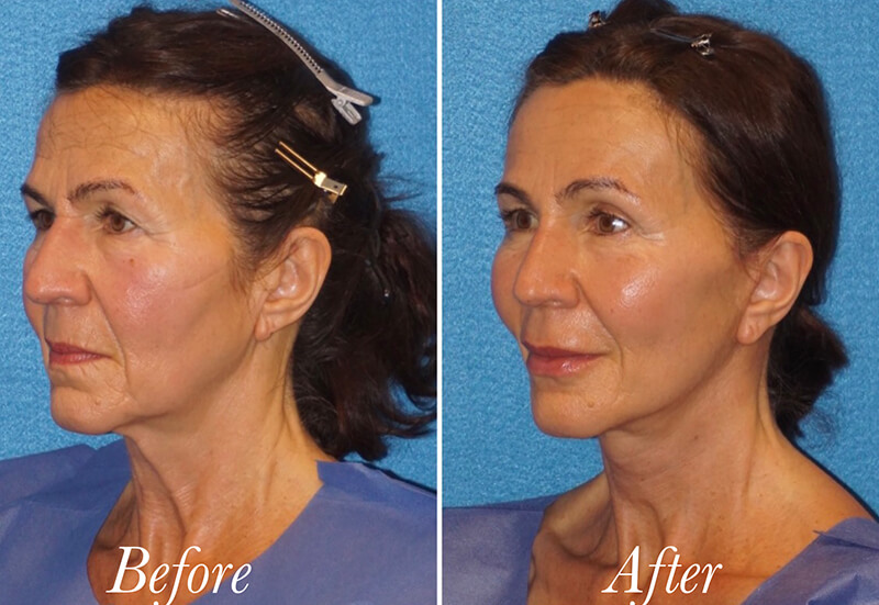 Facelift Before and After Patient 4