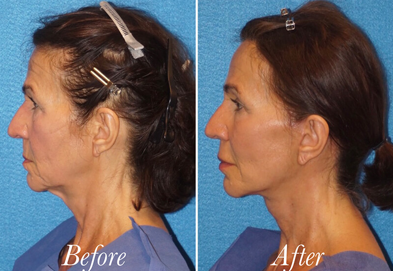 Facelift Before and After Patient 5
