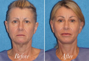 Facelift Before and After Patient Thumbnail 1
