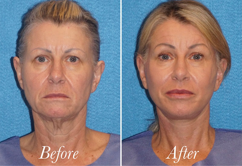 Facelift Before and After Patient 1