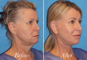 Facelift Before and After Patient Thumbnail 2