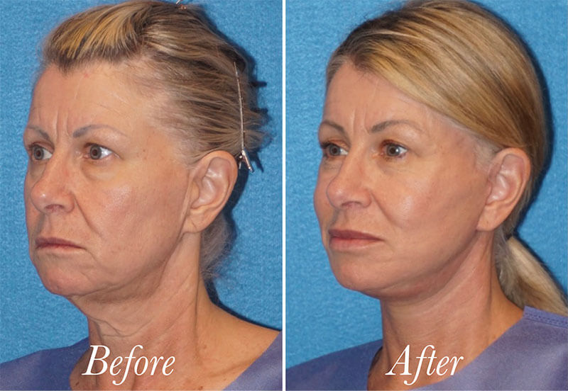 Facelift Before and After Patient 3