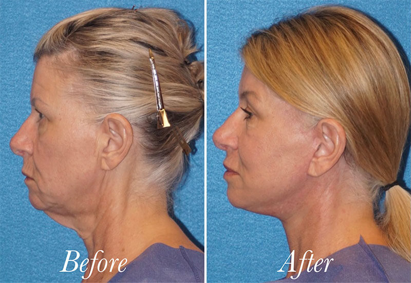 Facelift Before and After Patient 4