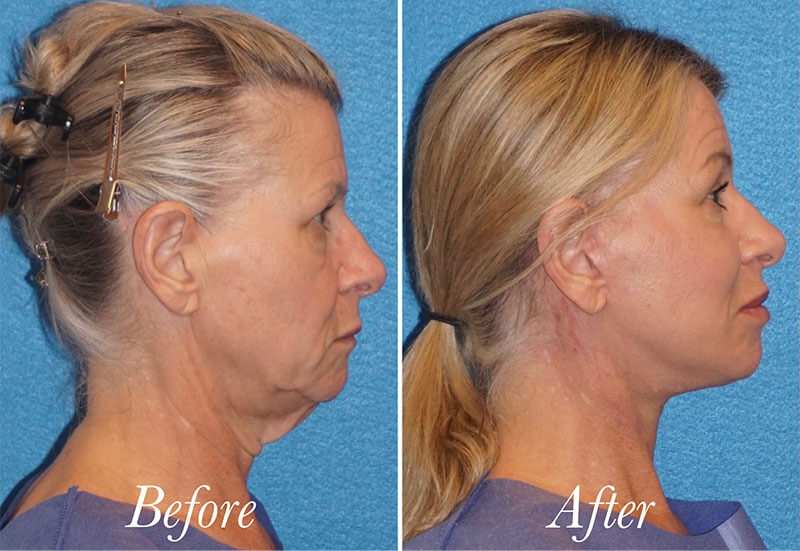 Facelift Before and After Patient 5
