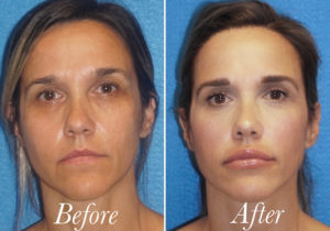 Fat Grafting Before and After Patient Thumbnail 1