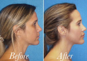 Fat Grafting Before and After Patient Thumbnail 3