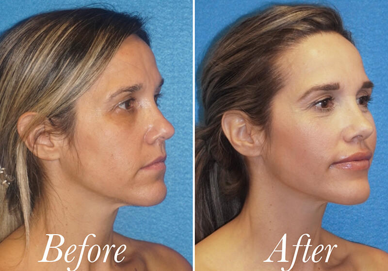 Fat Grafting Before and After Patient 2