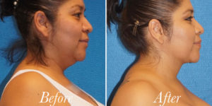 Body Before and After Patient Thumbnail 3