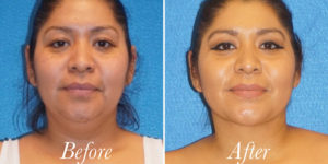 Body Before and After Patient Thumbnail 1