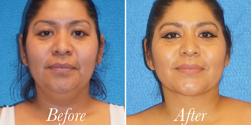 Body Before and After Patient 1