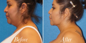 Body Before and After Patient Thumbnail 4