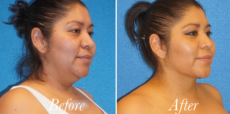 Body Before and After Patient 2