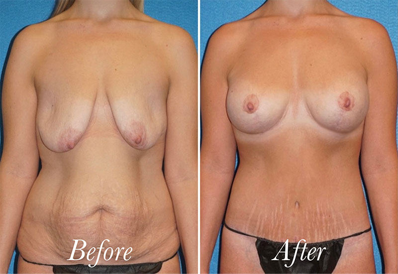 Breast Lift With Augmentation Before and After Patient 1