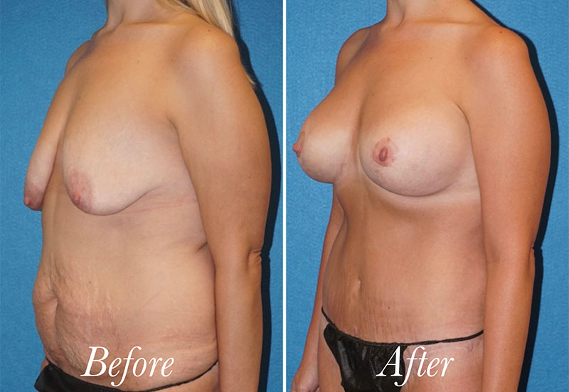 Breast Lift With Augmentation Before and After Patient 2